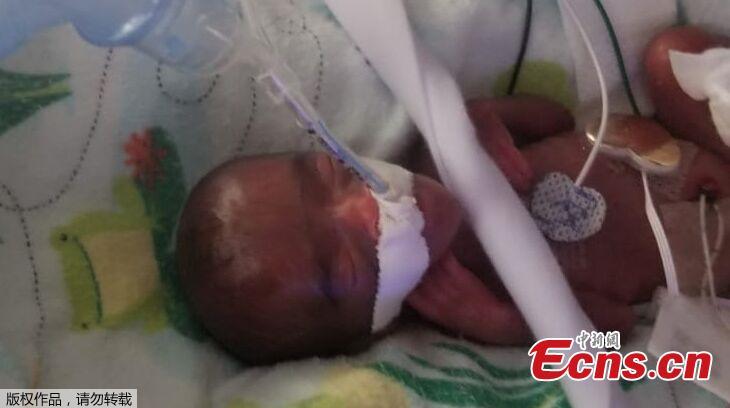 The picture shows baby Saybie, the world\'s smallest surviving newborn, when she was born in December 2018 in San Diego, California. A baby girl who weighed 245 grams and measured 23 cm became the smallest baby in the world, a US hospital reported after being discharged five months after being in intensive care.  (Photo/Agencies)